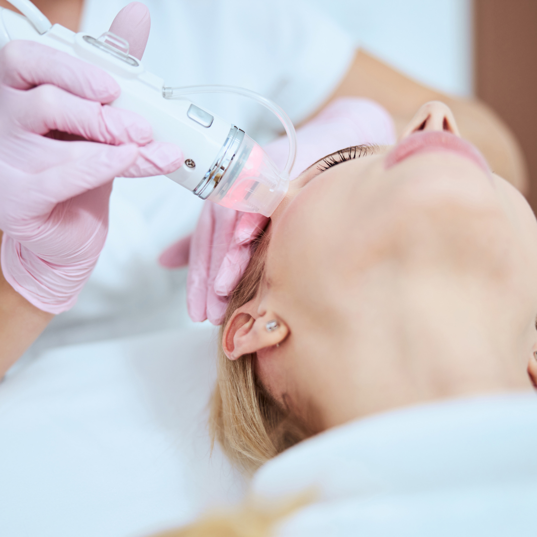 How to Treat Acne Scars with Microneedling